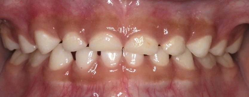 Image of a child's teeth taken on a smart phone